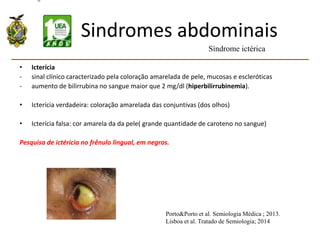 Sindromes abdominais
• Icterícia
- sinal clínico caracterizado pela coloração amarelada de pele, mucosas e escleróticas
- aumento de bilirrubina no sangue maior que 2 mg/dl (hiperbilirrubinemia).
• Icterícia verdadeira: coloração amarelada das conjuntivas (dos olhos)
• Icterícia falsa: cor amarela da da pele( grande quantidade de caroteno no sangue)
Pesquisa de ictéricia no frênulo lingual, em negros.
Síndrome ictérica
Porto&Porto et al. Semiologia Médica ; 2013.
Lisboa et al. Tratado de Semiologia; 2014
 