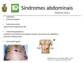 Síndromes abdominais
• Colelitíase.
• Colecistite Aguda.
• Colecistite crônica
-apresenta principalmente dor.
• Colecistite gangrenosa
-colecistite com bactérias formadoras de gás, mais comum em diabéticos.
-operada imediatamente
• Pancreatite aguda.
Síndrome ictérica
Porto&Porto et al. Semiologia Médica ; 2013.
Lisboa et al. Tratado de Semiologia; 2014
 