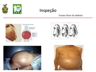 Inspeção
Exame físico do abdome
 