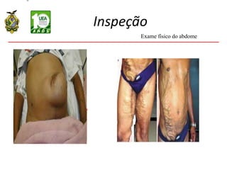 Inspeção
Exame físico do abdome
 
