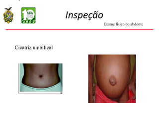 Inspeção
Cicatriz umbilical
Exame físico do abdome
 