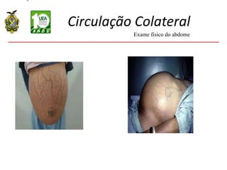 Circulação Colateral
Exame físico do abdome
 