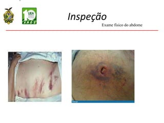 Inspeção
Exame físico do abdome
 