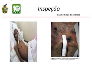 Inspeção
Exame físico do abdome
 