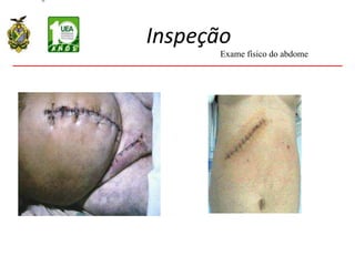 Inspeção
Exame físico do abdome
 
