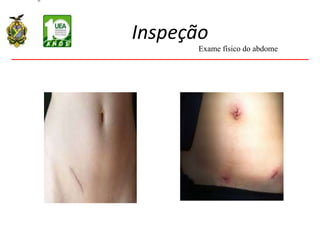 Inspeção
Exame físico do abdome
 
