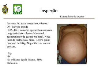 Inspeção
Paciente JK, sexo masculino, 44anos.
QP- Barriga grande
HDA- Há 3 semanas apresentou aumento
progressivo do volume abdominal,
acompanhado de edema em mmii. Nega
fator de melhora ou piora. Refere ganho
ponderal de 10kg. Nega febre ou outras
queixas.
Hpp-
hf-
Hs- etilismo desde 16anos. 560g
etanol/dia
Exame físico do abdome
 