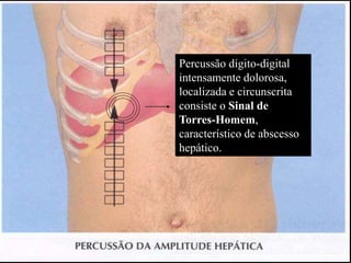 Percussão dígito-digital
intensamente dolorosa,
localizada e circunscrita
consiste o Sinal de
Torres-Homem,
característico de abscesso
hepático.
 