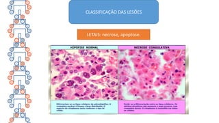 CLASSIFICAÇÃO DAS LESÕES
LETAIS: necrose, apoptose.
 