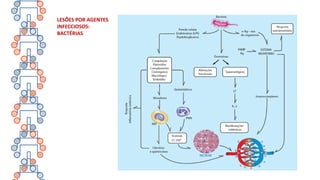 LESÕES POR AGENTES
INFECCIOSOS:
BACTÉRIAS
 