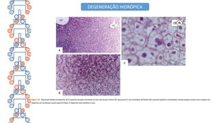 DEGENERAÇÃO HIDRÓPICA
 