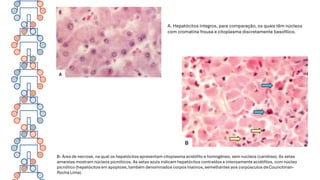 B- Área de necrose, na qual os hepatócitos apresentam citoplasma acidófilo e homogêneo, sem núcleos (cariólise). As setas
amarelas mostram núcleos picnóticos. As setas azuis indicam hepatócitos contraídos e intensamente acidófilos, com núcleo
picnótico (hepatócitos em apoptose, também denominados corpos hialinos, semelhantes aos corpúsculos deCouncilman-
Rocha Lima).
A. Hepatócitos íntegros, para comparação, os quais têm núcleos
com cromatina frouxa e citoplasma discretamente basofílico.
 