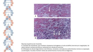 Necrose isquêmica do miocárdio.
A. Cariólise de miocélulas, que mostram citoplasma homogêneo e muito acidófilo (necrose por coagulação). As
setas indicam núcleos picnóticos, sobretudo em células do estroma.
B. Infiltração de células fagocitárias e de linfócitos, iniciando a remoção de cardiomiócitos mortos e a reparação
(cicatrização). As setas mostram restos de cardiomiócitos mortos entre os fagócitos.
 
