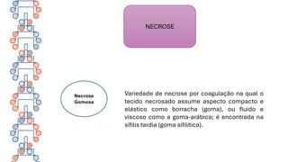 NECROSE
Necrose
Gomosa
Variedade de necrose por coagulação na qual o
tecido necrosado assume aspecto compacto e
elástico como borracha (goma), ou fluido e
viscoso como a goma-arábica; é encontrada na
sífilis tardia (goma sifilítica).
 