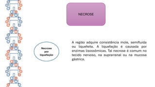 NECROSE
Necrose
por
liquefação
A região adquire consistência mole, semifluida
ou liquefeita. A liquefação é causada por
enzimas lisossômicas. Tal necrose é comum no
tecido nervoso, na suprarrenal ou na mucosa
gástrica.
 
