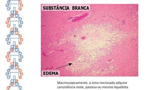 Macroscopicamente, a zona necrosada adquire
consistência mole, pastosa ou mesmo liquefeita.
 