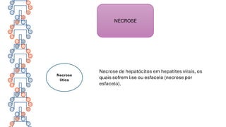 NECROSE
Necrose
lítica
Necrose de hepatócitos em hepatites virais, os
quais sofrem lise ou esfacelo (necrose por
esfacelo).
 