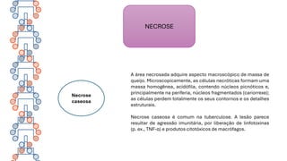 NECROSE
Necrose
caseosa
A área necrosada adquire aspecto macroscópico de massa de
queijo. Microscopicamente, as células necróticas formam uma
massa homogênea, acidófila, contendo núcleos picnóticos e,
principalmente na periferia, núcleos fragmentados (cariorrexe);
as células perdem totalmente os seus contornos e os detalhes
estruturais.
Necrose caseosa é comum na tuberculose. A lesão parece
resultar de agressão imunitária, por liberação de linfotoxinas
(p. ex., TNF-α) e produtos citotóxicos de macrófagos.
 
