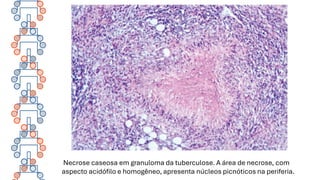Necrose caseosa em granuloma da tuberculose. A área de necrose, com
aspecto acidófilo e homogêneo, apresenta núcleos picnóticos na periferia.
 