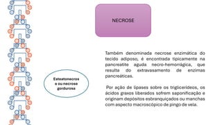 NECROSE
Esteatonecros
e ou necrose
gordurosa
Também denominada necrose enzimática do
tecido adiposo, é encontrada tipicamente na
pancreatite aguda necro-hemorrágica, que
resulta do extravasamento de enzimas
pancreáticas.
Por ação de lipases sobre os triglicerídeos, os
ácidos graxos liberados sofrem saponificação e
originam depósitos esbranquiçados ou manchas
com aspecto macroscópico de pingo de vela.
 