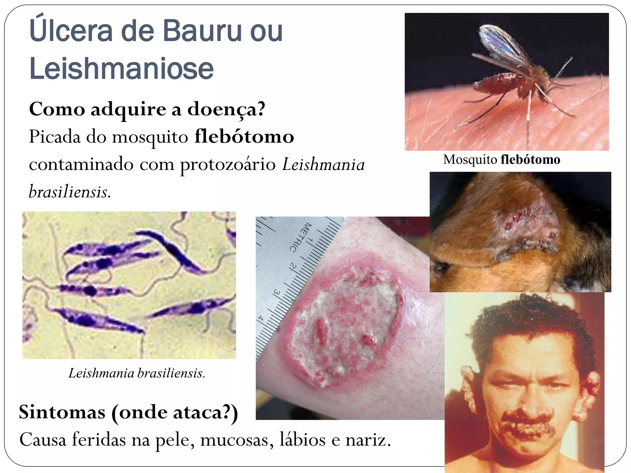 Úlcera de Bauru ou
Leishmaniose
Como adquire a doença?
Picada do mosquito flebótomo
contaminado com protozoário Leishmania
brasiliensis.
Sintomas (onde ataca?)
Causa feridas na pele, mucosas, lábios e nariz.
Mosquito flebótomo
Leishmania brasiliensis.
 