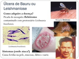 Úlcera de Bauru ou
Leishmaniose
Como adquire a doença?
Picada do mosquito flebótomo
contaminado com protozoário Leishmania
brasiliensis.
Sintomas (onde ataca?)
Causa feridas na pele, mucosas, lábios e nariz.
Mosquito flebótomo
Leishmania brasiliensis.
 