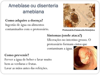 Amebíase ou disenteria
amebiana
Como adquire a doença?
Ingestão de água ou alimentos
contaminados com o protozoário.
Sintomas (onde ataca?)
Ulcerações no intestino grosso. O
protozoário formam cistos que
contaminam a água.
Como prevenir?
Ferver a água de beber e lavar muito
bem as verduras e frutas.
Lavar as mãos antes das refeições.
Protozoário Entamoeba histolytica
 
