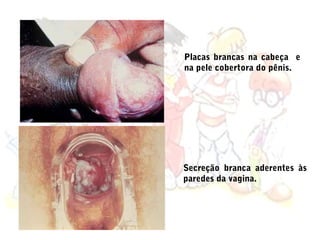 Placas brancas na cabeça e
na pele cobertora do pênis.




Secreção branca aderentes às
paredes da vagina.
 