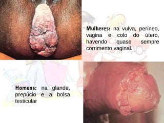 Mulheres: na vulva, períneo,
                     vagina e colo do útero,
                     havendo     quase    sempre
                     corrimento vaginal.




Homens: na glande,
prepúcio e a bolsa
testicular
 
