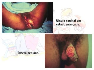 Úlcera vaginal em
                  estado avançado.




Úlcera peniana.
 