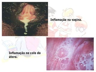Inflamação na vagina.




Inflamação no colo do
útero.
 