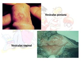 Vesículas peniana




Vesículas vaginal
 