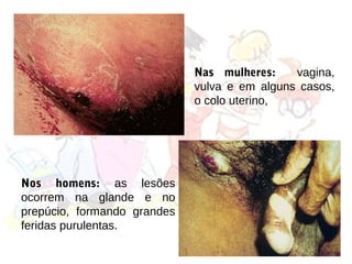Nas mulheres:    vagina,
                             vulva e em alguns casos,
                             o colo uterino,




Nos homens: as lesões
ocorrem na glande e no
prepúcio, formando grandes
feridas purulentas.
 