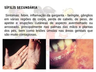 SÍFILIS SECUNDÁRIA

 Sintomas: febre, inflamação da garganta - faringite, gânglios
em várias regiões do corpo, perda de cabelo, de peso, de
apetite e erupções cutâneas de aspecto avermelhado ou
arroxeado, principalmente nas palmas das mãos e plantas
dos pés, bem como lesões úmidas nas áreas genitais que
são muito contagiosas.
 