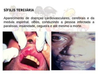 SÍFILIS TERCIÁRIA

Aparecimento de doenças cardiovasculares, cerebrais e da
medula espinhal, olhos, conduzindo a pessoa infectada a
paralisias, insanidade, cegueira e até mesmo a morte.
 