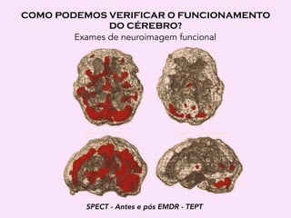 COMO PODEMOS VERIFICAR O FUNCIONAMENTO
DO CÉREBRO? 
Exames de neuroimagem funcional
SPECT - Antes e pós EMDR - TEPT
 