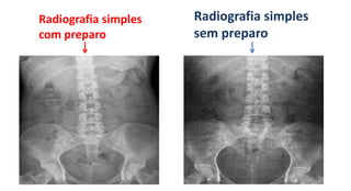 Radiografia simples
com preparo
Radiografia simples
sem preparo
 