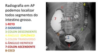 Radiografia em AP
podemos localizar
todos segmentos do
intestino grosso.
1-RETO
2-SIGMOIDE
3-COLON DESCENDENTE
4-ÂNGULO ESPLÊNICO
5-COLON TRANSVERSO
6-ÂNGULO HEPATICO
7-COLON ASCENDENTE
8-CECO
1
2
3
4
5
6
7
8
 