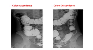 Colon Ascendente Colon Descendente
 