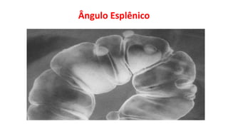 Ângulo Esplênico
 