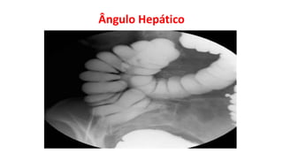 Ângulo Hepático
 