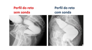 Perfil do reto
sem sonda
Perfil do reto
com sonda
 