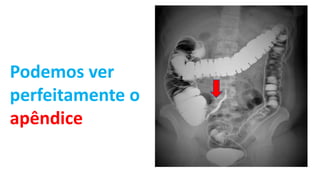 Podemos ver
perfeitamente o
apêndice
 