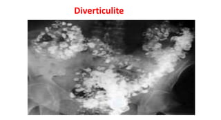 Diverticulite
 