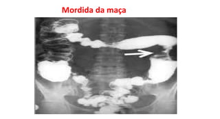 Mordida da maça
 