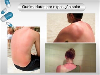 Queimaduras por exposição solar
 