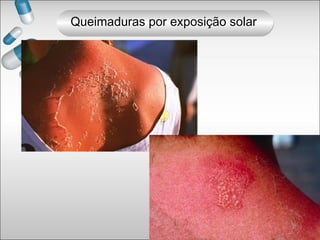 Queimaduras por exposição solar
 