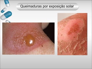 Queimaduras por exposição solar
 