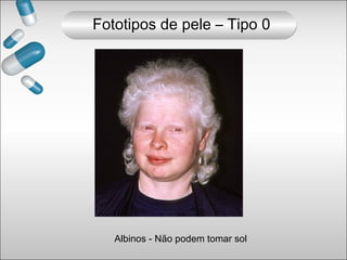 Fototipos de pele – Tipo 0
Albinos - Não podem tomar sol
 
