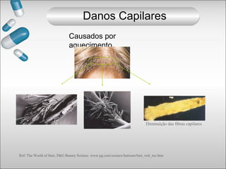 Causados por
aquecimento
Ref: The World of Hair, P&G Beauty Science. www.pg.com/science/haircare/hair_twh_toc.htm
Diminuição das fibras capilares
Danos Capilares
 